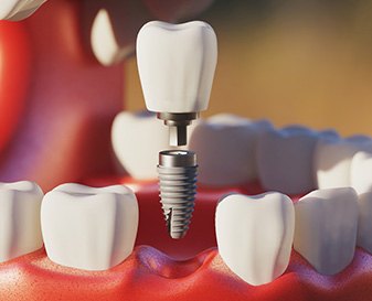 Digital image of a single dental implant
