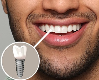 Up-close view of a person’s smile and a dental implant image
