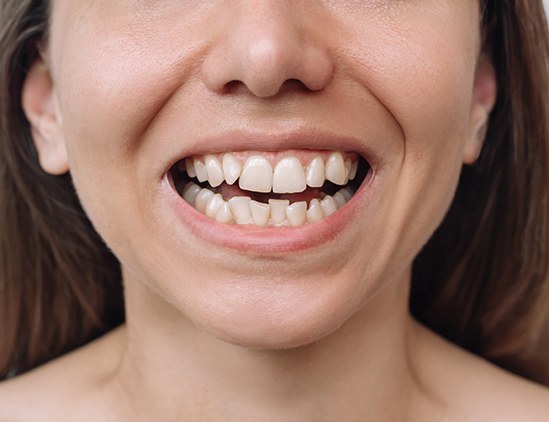 Nose-to-shoulder view of woman with crooked teeth smiling