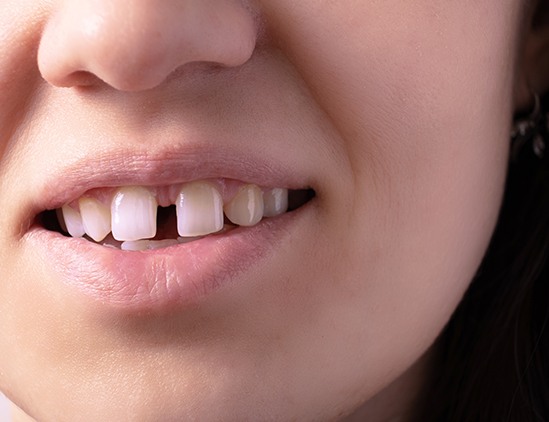 Nose-to-chin view of someone with a gap between teeth