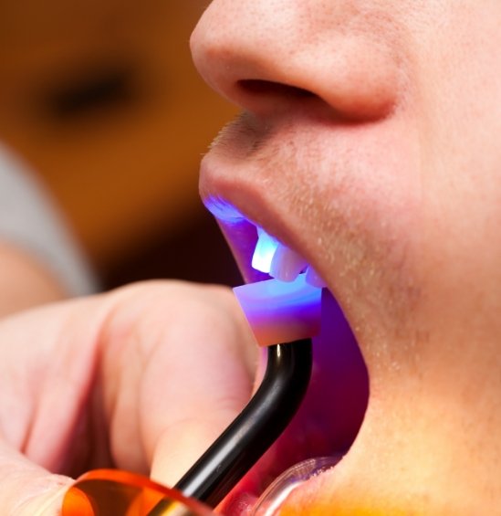 Close up of dental patient having tooth treated with cosmetic bonding