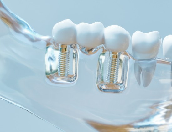 Model of the mouth with two dental implants supporting a dental bridge