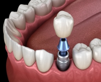 Dental crown being placed onto dental implant