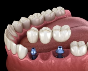 Dental bridge being placed onto two dental implants