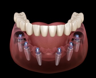 Full denture being placed onto six dental implants