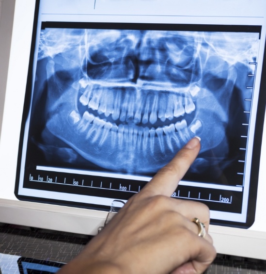 Dentist pointing to impacted wisdom tooth on digital dental x ray