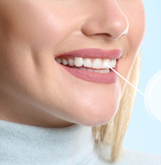 Nose-to-neck view of woman smiling with front tooth indicated as an implant