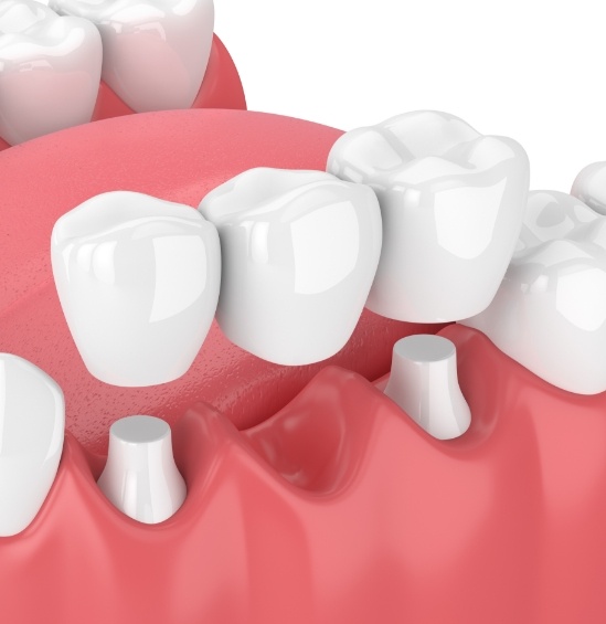 Illustrated dental bridge being fitted to replace a missing tooth