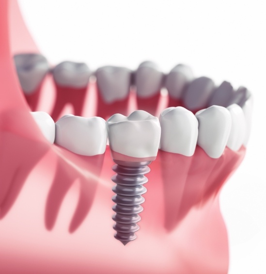 Illustrated dental implant with crown in lower jaw
