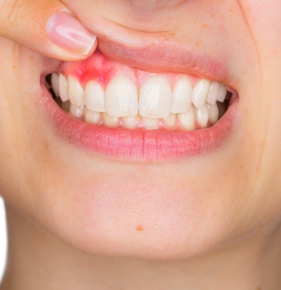 Close up of person pointing to red spot on their gums