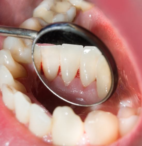 Close up of dental mirror showing red spot in gums