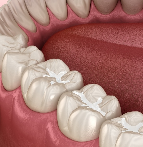 Illustrated row of teeth with barely noticeable tooth colored fillings