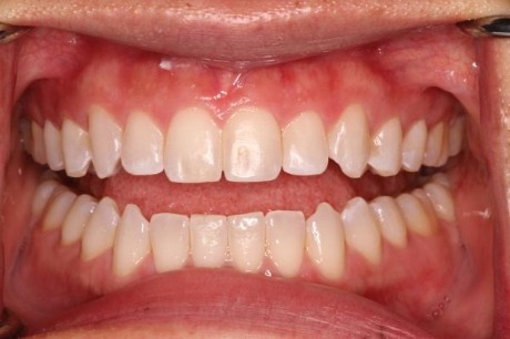 Mouth with well aligned teeth