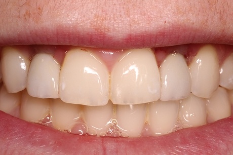 Smile with a complete row of upper teeth