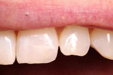 Smile after correcting chipped upper tooth