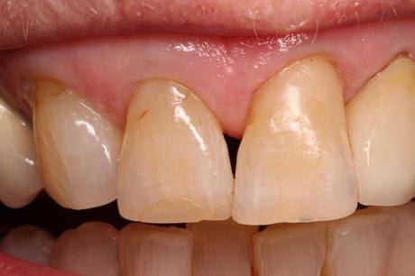 Close up of even two front teeth after dental bonding