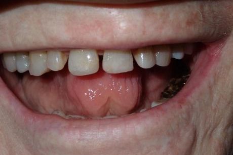 Dental patient smiling after fixing discolored tooth