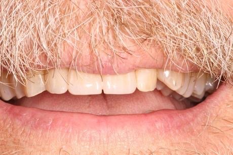 Man smiling with full set of upper teeth