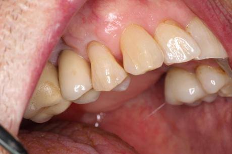 Close up of tooth with old filling replaced by dental bonding
