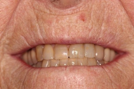 Senior woman with full set of teeth