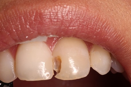 Close up of chipped front tooth