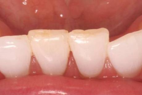 Close up of uneven row of teeth