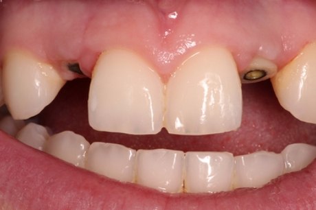 Smile missing one tooth on either side of two front teeth