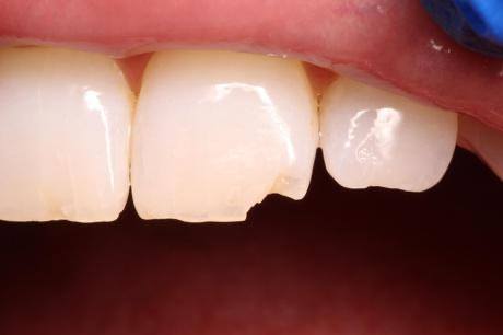 Close up of chipped upper tooth