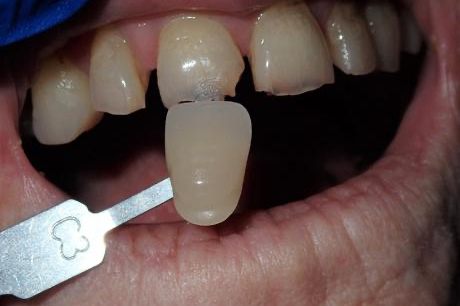 Dentist holding shade guide in front of discolored tooth in smile