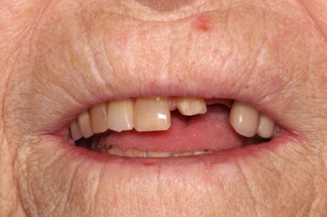 Senior woman with missing front tooth