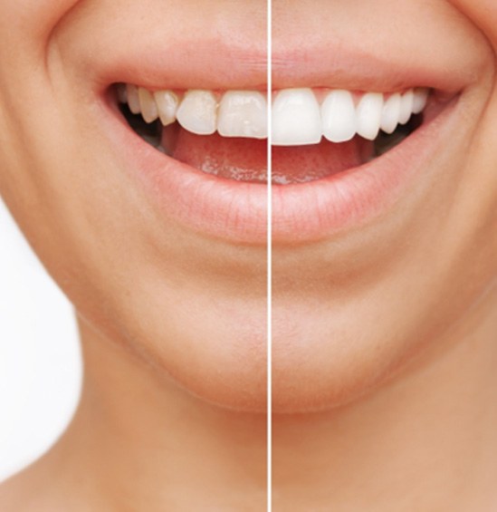 Patient's smile before and after veneers