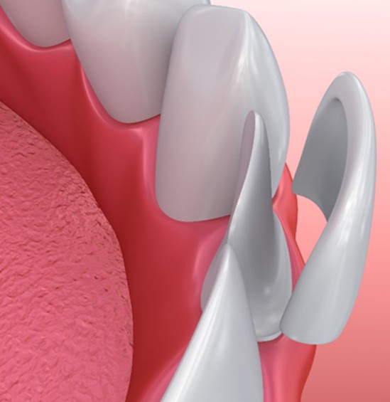 Illustration of veneer being placed on bottom tooth